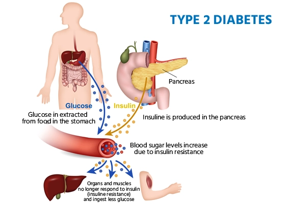 Type 2 Diabetes